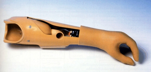 Versorgung bei Unterarmamputation